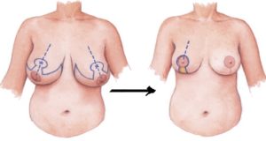 mamoplastia de reduccion medellin
