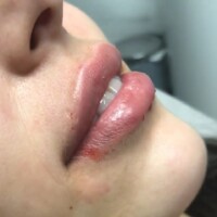 Aumento de labios relleno labios medellin