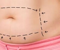 Abdominoplastia abdominoplastia medellin