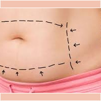 Abdominoplastia abdominoplastia medellin